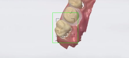 ABFORMLÖFFEL ADEE – DIGITALE ABFORMUNG