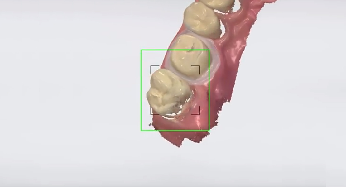 ABFORMLÖFFEL ADEE – DIGITALE ABFORMUNG